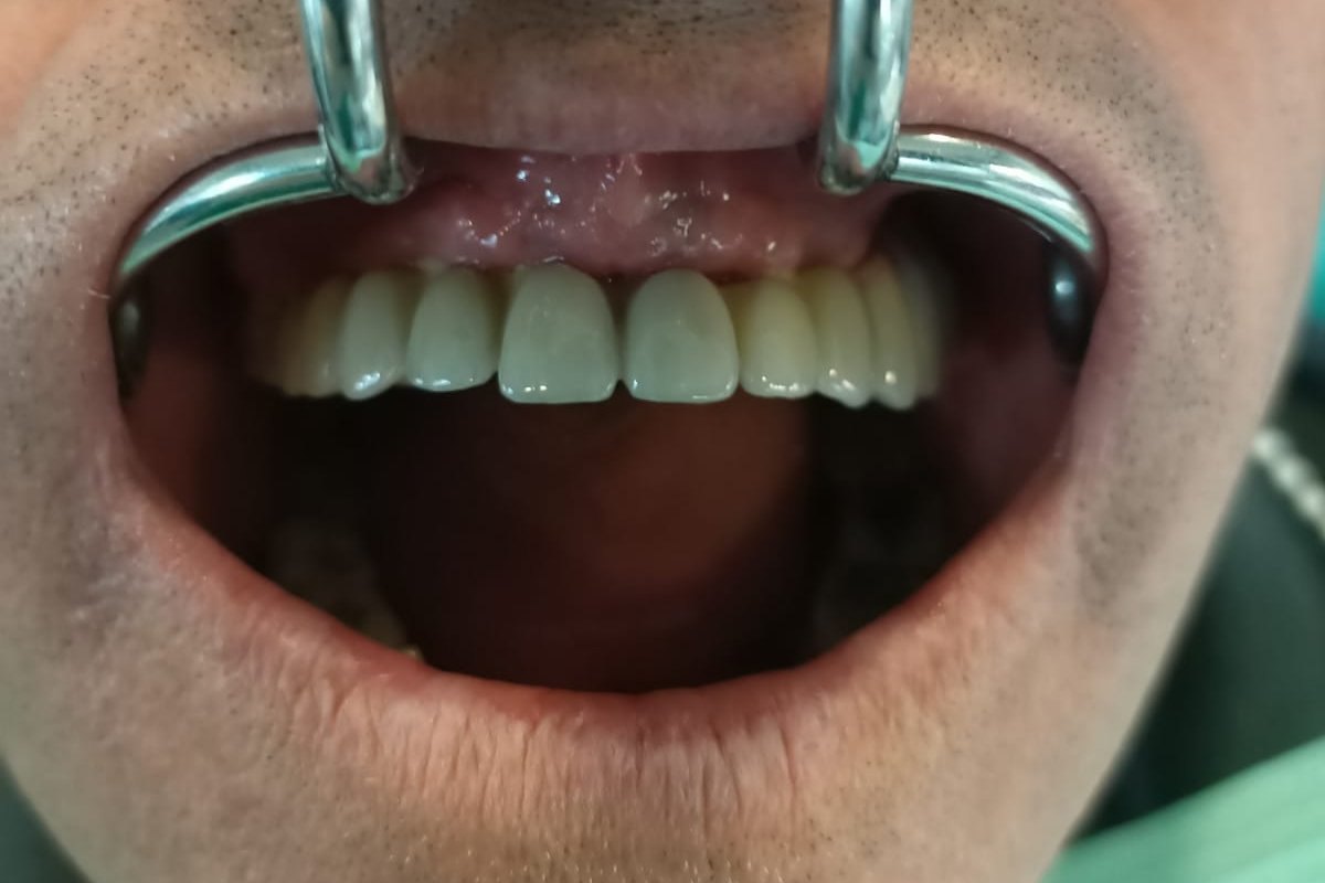 Clinica Dental Amaro - Protesis